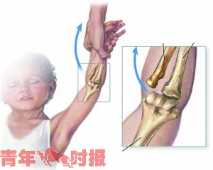 牵孩子走路是门技术活 杭州不少伢儿的手就被拽脱臼了