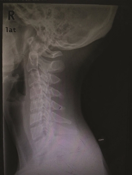泰勒脖子为什么总是向前倾？保护颈椎注意两点