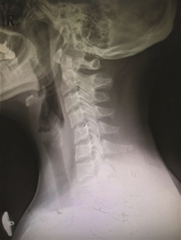 泰勒脖子为什么总是向前倾？保护颈椎注意两点
