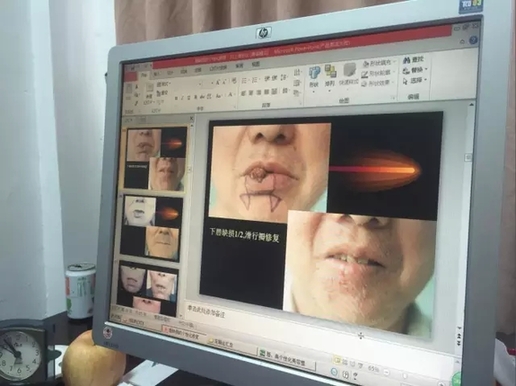 嘴唇长个小肿块 医院一查竟是癌!不做好防晒措施竟然还会得这病 嘴唇长个小肿块 医院一查竟是癌!不做好防晒措施竟然还会得这病